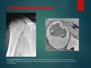 Condroblastoma
TC de condroblastoma. (A) RX AP do ombro mostra lesão na epífise proximal do úmero, com a presença de
calcificações. Camada bem organizada de reação periosteal na cortical lateral. (B) Corte de TC mostra claramente
as calcificações.
 