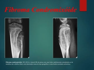 Fibroma Condromixóide
Fibroma condromixóide: RX AP(A) e lateral (B) de perna com uma lesão radioluscente estendendo-se da
metáfise até a diáfise tibial, com destruição óssea do tipo geográfico e uma borda recortada esclerótica.
 