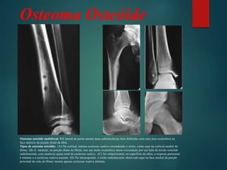 Osteoma Osteóide
Osteoma osteóide multifocal: RX lateral da perna mostra duas radiolucências bem definidas com uma área esclerótica na
face anterior da porção distal da tíbia.
Tipos de osteoma osteóide: (A) Na cortical, intensa esclerose reativa circundando o nicho, como aqui na cortical medial do
fêmur. (B) A medular, na porção distai da fíbula, tem um nicho esclerótico denso circundado por um halo de tecido osteóide
radioluscente, com ausência quase total de esclerose reativa . (C) No subperiosteal, na superfície do tálus, a resposta periosteal
é mínima e a esclerose reativa ausente. (D) No intracapsular, o nicho radioluscente observado aqui na face medial da porção
proximal do colo do fêmur mostra apenas esclerose reativa mínima.
 