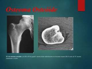 Osteoma Osteóide
TC de osteoma osteóide: (A) RX AP do quadril mostra lesão radioluscente no trocanter menor (B) O corte de TC mostra
claramente o nicho.
 