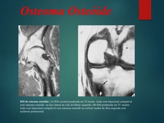 Osteoma Osteóide
RM de osteoma osteóide: (A) RM coronal ponderada em Tl mostra lesão com hipossinal compatível
com osteoma osteóide na face lateral do colo do fêmur esquerdo. (B) RM ponderada em Tl mostra
lesão com hipossinal compatível com osteoma osteóide na cortical mediai da tíbia esquerda com
esclerose perilesional.
 