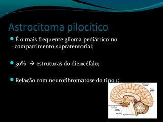 Astrocitoma pilocítico
É o mais frequente glioma pediátrico no
compartimento supratentorial;
30%  estruturas do diencéfalo;
Relação com neurofibromatose do tipo 1;
 