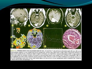 Tumores supratentoriais .