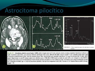 Astrocitoma pilocítico
 