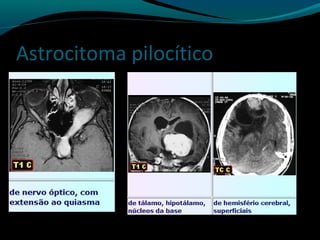 Astrocitoma pilocítico
 