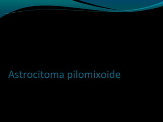 Astrocitoma pilomixoide
 