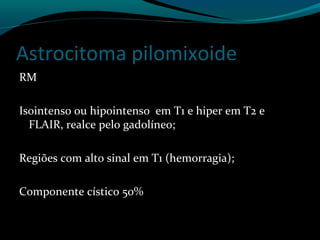 Astrocitoma pilomixoide
RM
Isointenso ou hipointenso em T1 e hiper em T2 e
FLAIR, realce pelo gadolíneo;
Regiões com alto sinal em T1 (hemorragia);
Componente cístico 50%
 