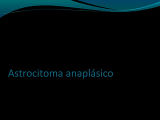 Astrocitoma anaplásico
 