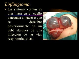Linfangioma.Un síntoma común es una masa en el cuello detectada al nacer o que se descubre posteriormente en un bebé después de una infección de las vías respiratorias altas.