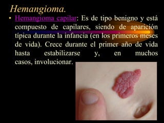 Hemangioma.Hemangioma capilar: Es de tipo benigno y está compuesto de capilares, siendo de aparición típica durante la infancia (en los primeros meses de vida). Crece durante el primer año de vida hasta estabilizarse y, en muchos casos, involucionar. 