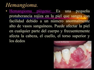 Hemangioma.Hemangioma piógeno: Es una pequeña protuberancia rojiza en la piel que sangra con facilidad debido a un número anormalmente alto de vasos sanguíneos. Puede afectar la piel en cualquier parte del cuerpo y frecuentemente afecta la cabeza, el cuello, el torso superior y los dedos