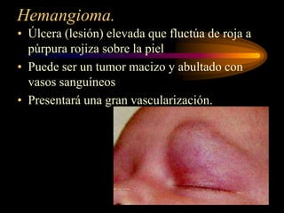 Hemangioma.Úlcera (lesión) elevada que fluctúa de roja a púrpura rojiza sobre la pielPuede ser un tumor macizo y abultado con vasos sanguíneosPresentará una gran vascularización.