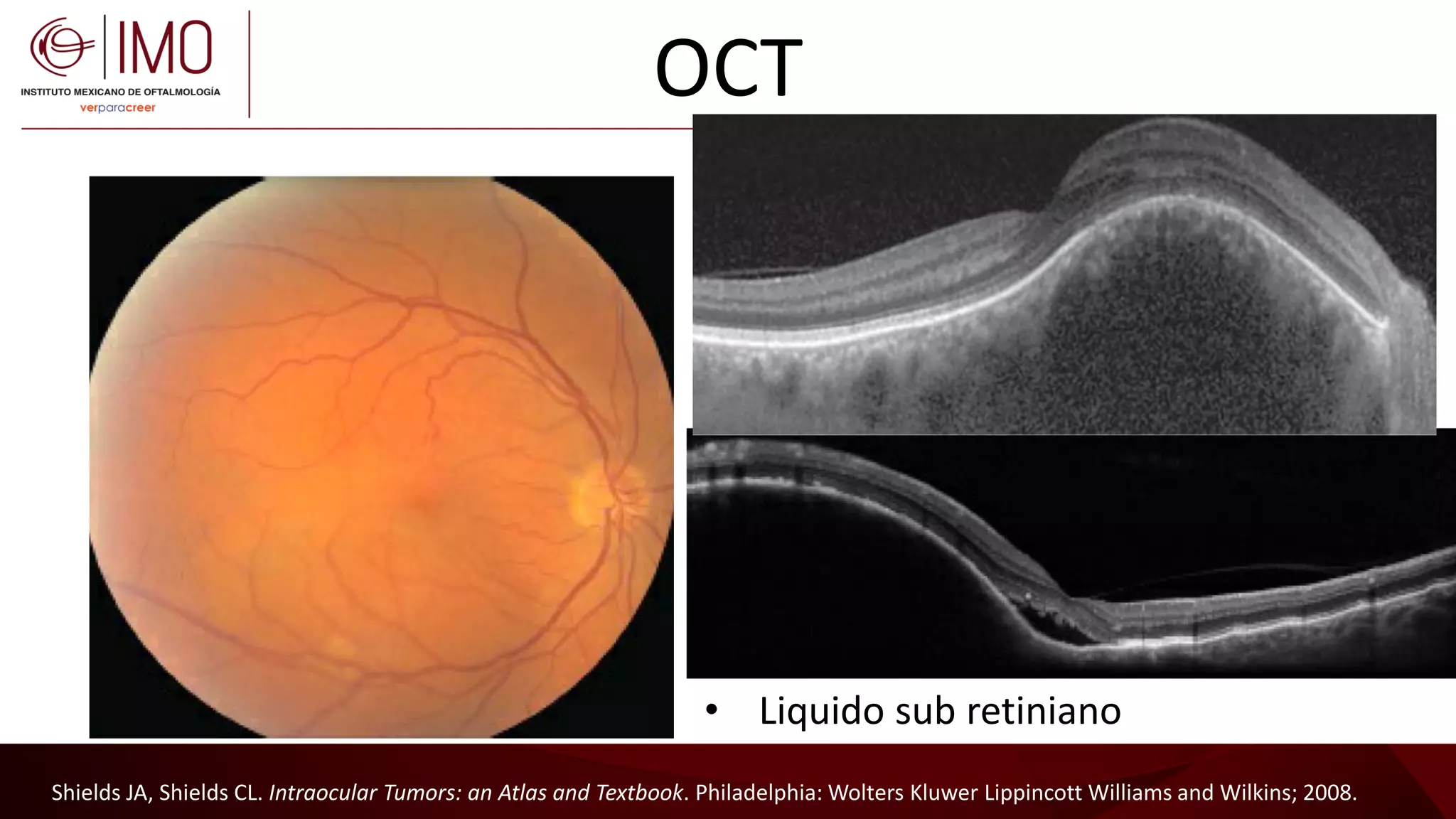 Tumores vasculares de la retina y coroides - Vascular tumors of the ...