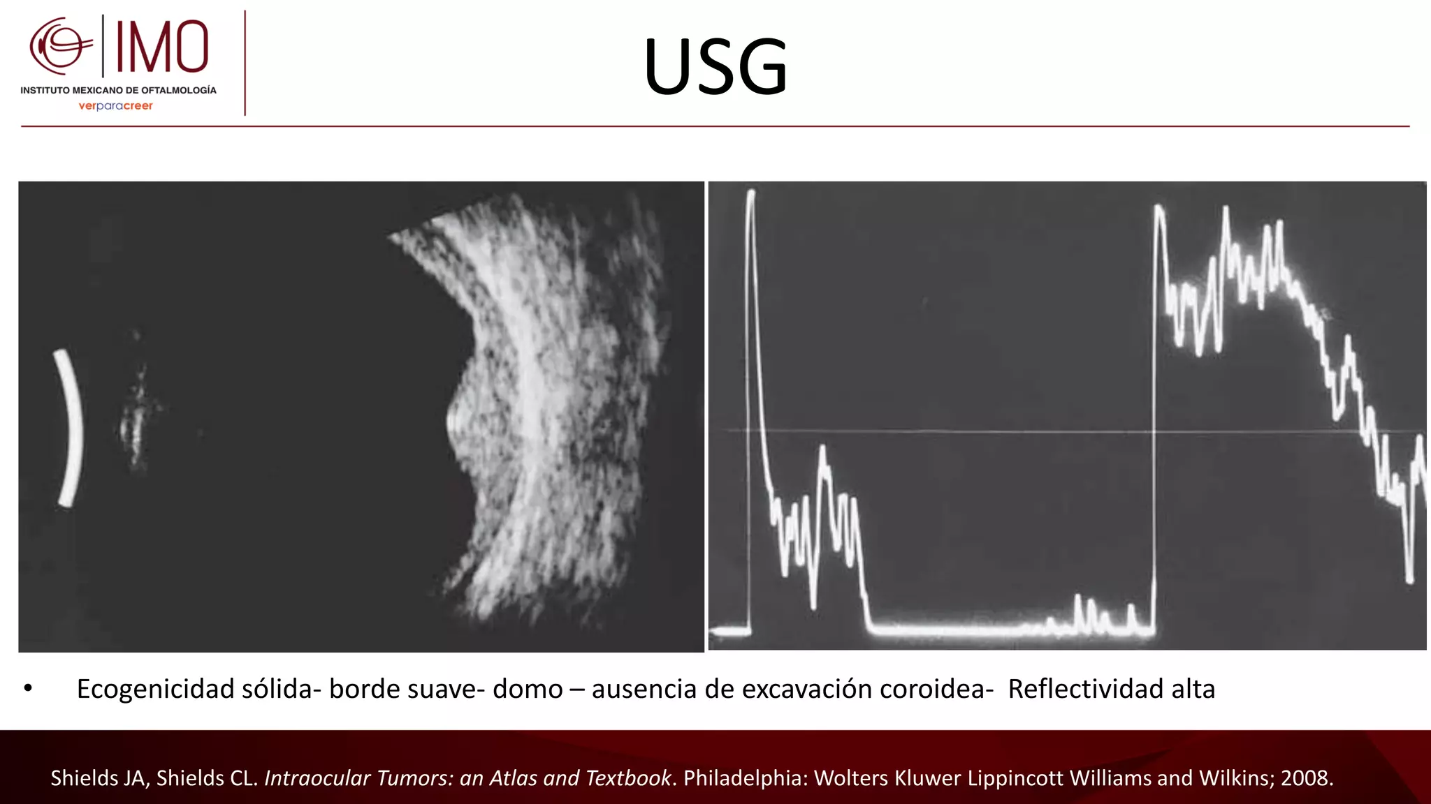 Tumores vasculares de la retina y coroides - Vascular tumors of the ...
