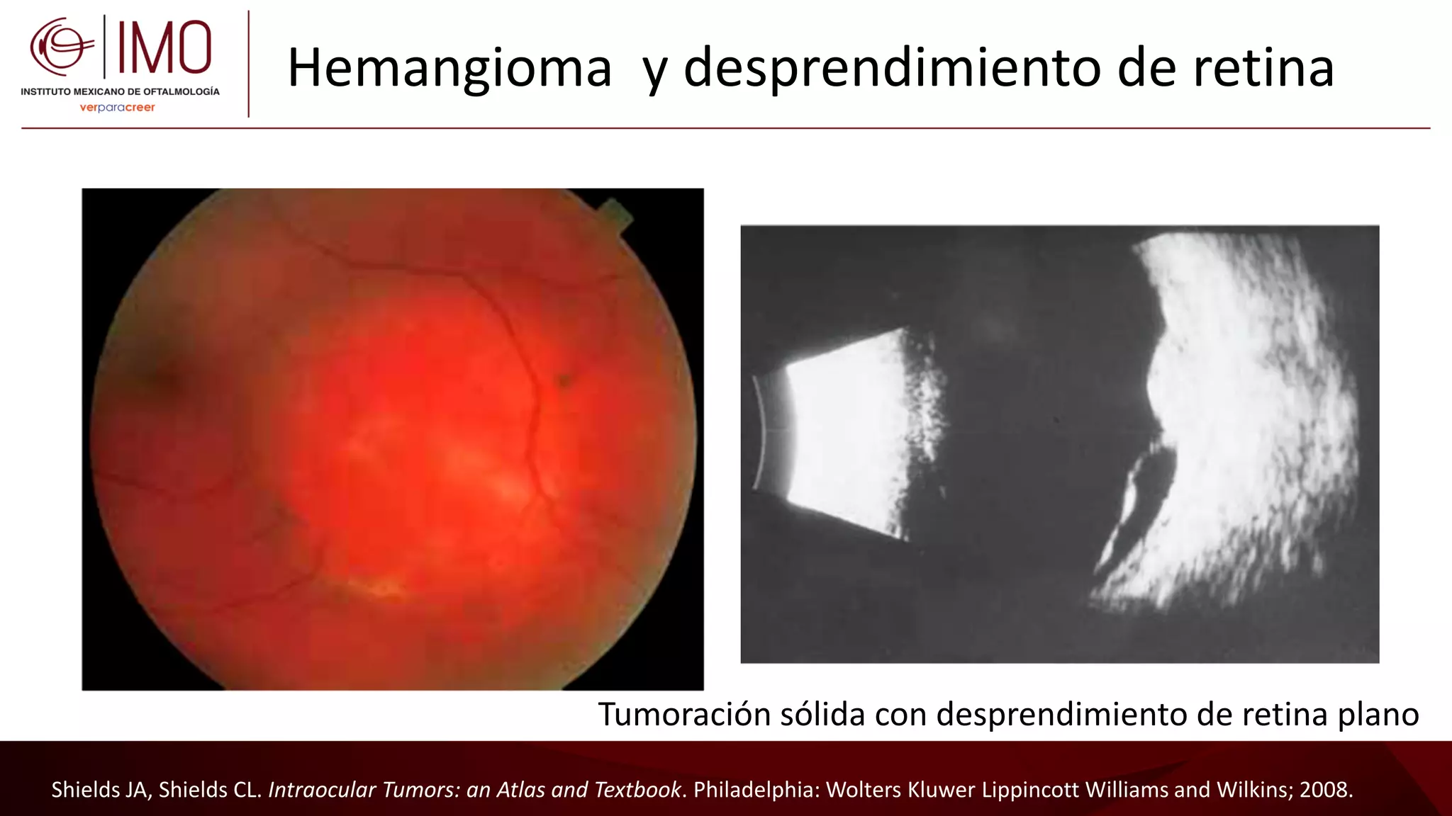 Tumores vasculares de la retina y coroides - Vascular tumors of the ...