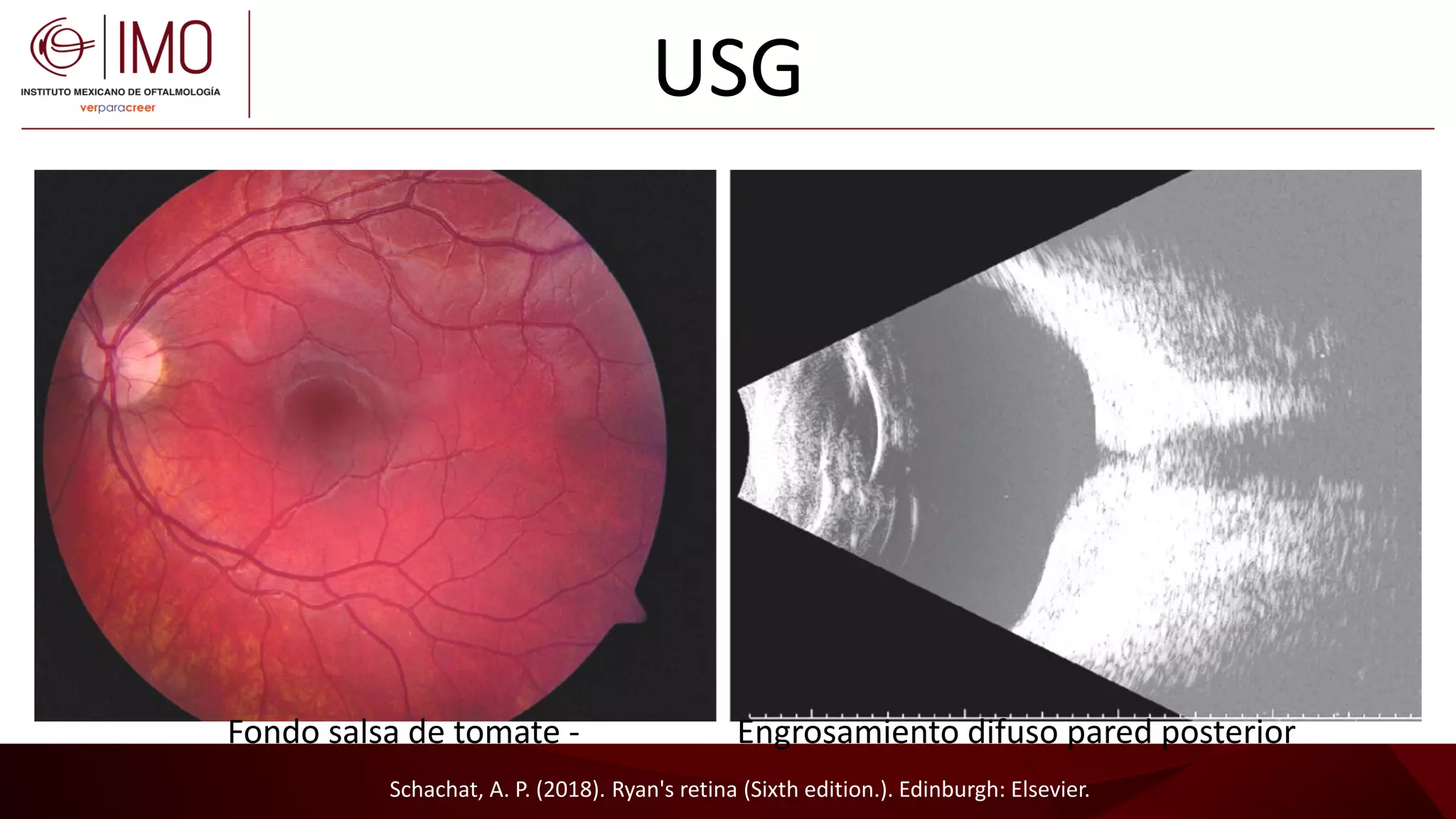 Tumores vasculares de la retina y coroides - Vascular tumors of the ...