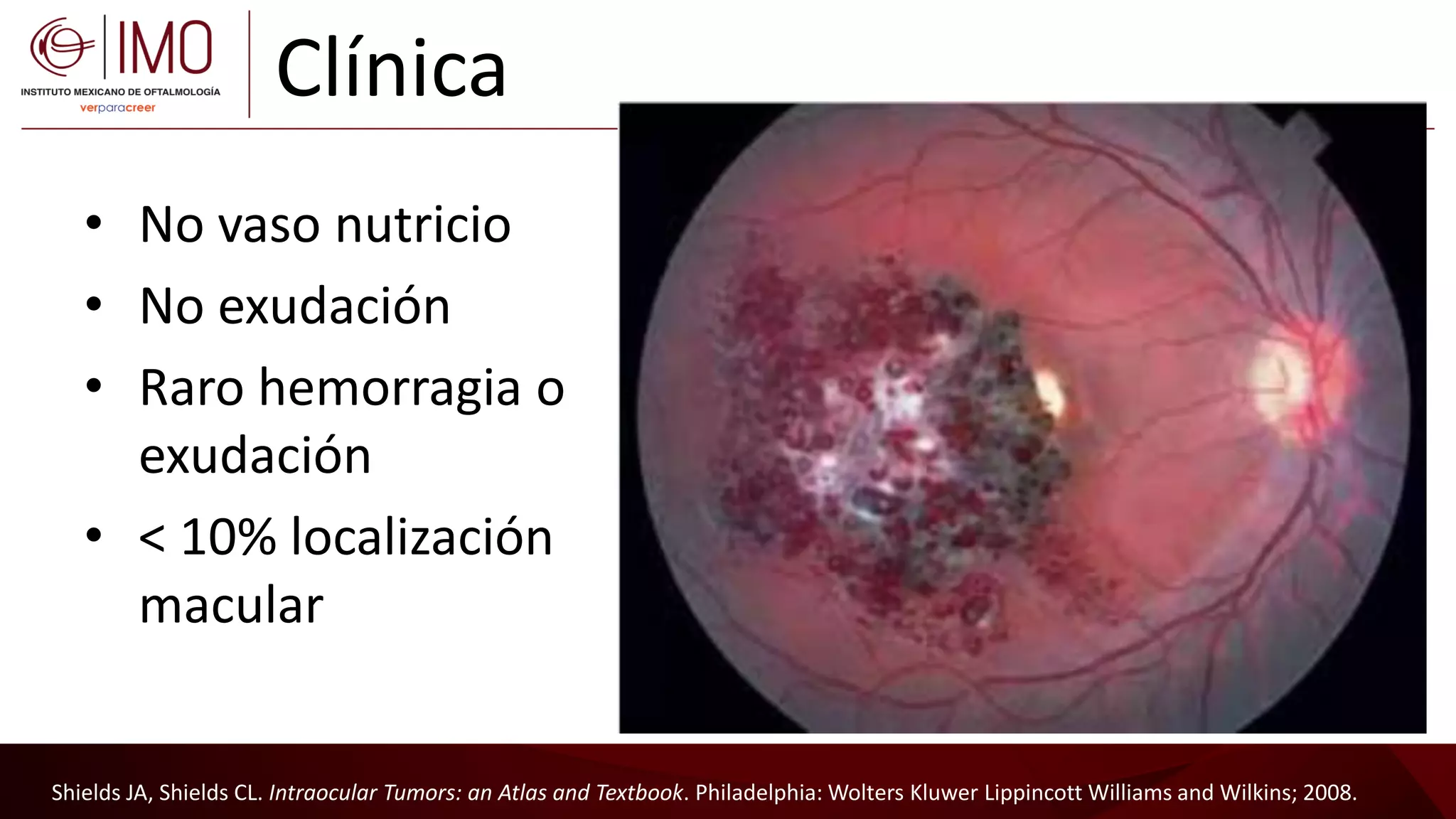 Tumores vasculares de la retina y coroides - Vascular tumors of the ...