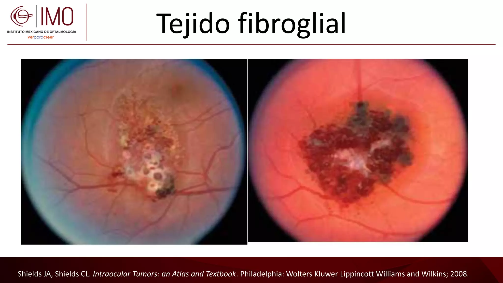 Tumores vasculares de la retina y coroides - Vascular tumors of the ...
