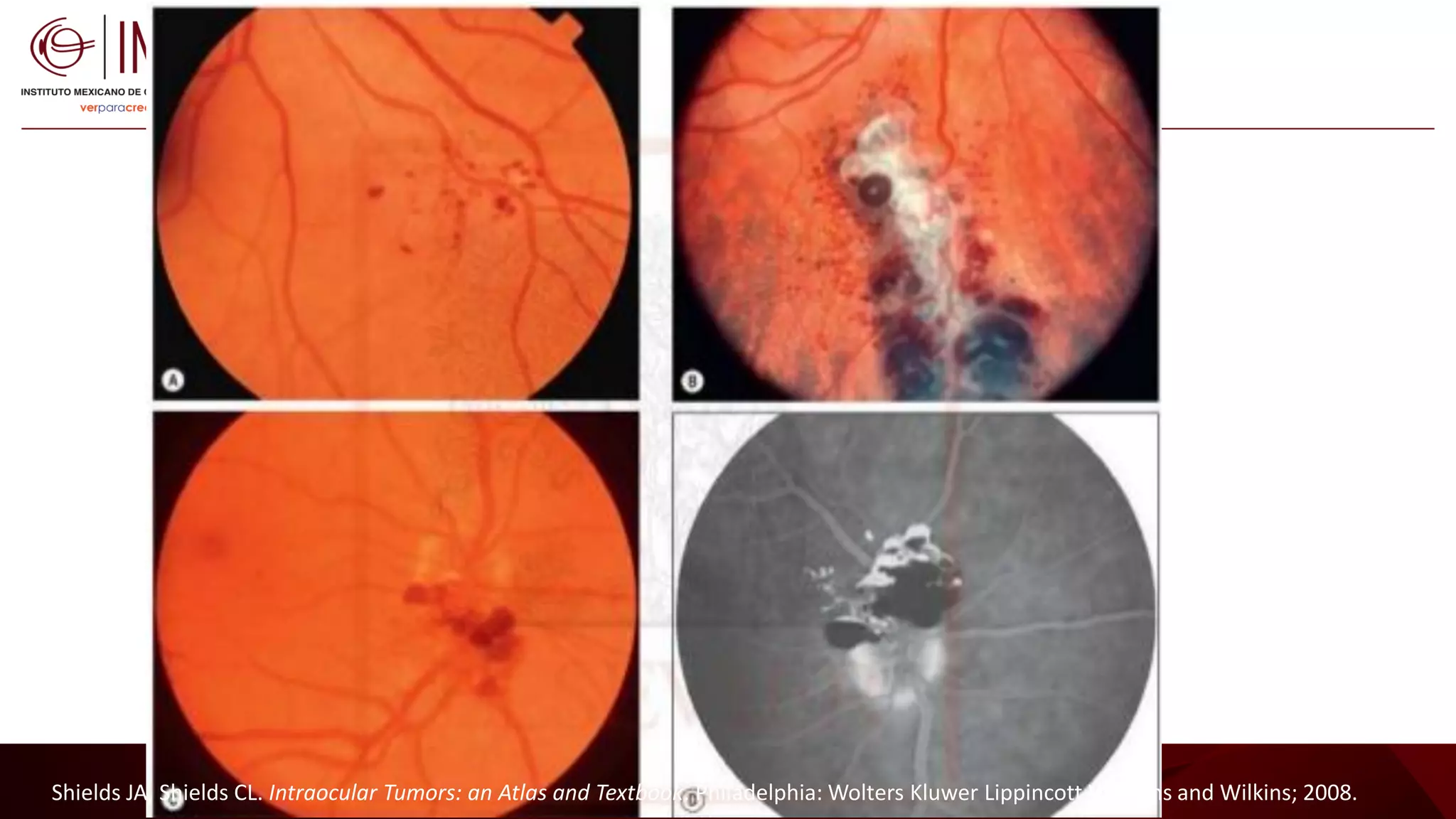 Tumores vasculares de la retina y coroides - Vascular tumors of the ...