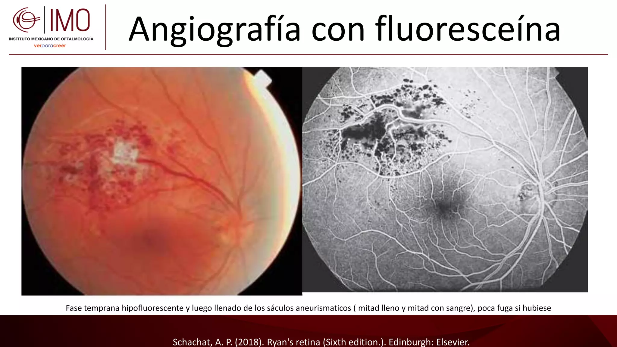 Tumores vasculares de la retina y coroides - Vascular tumors of the ...