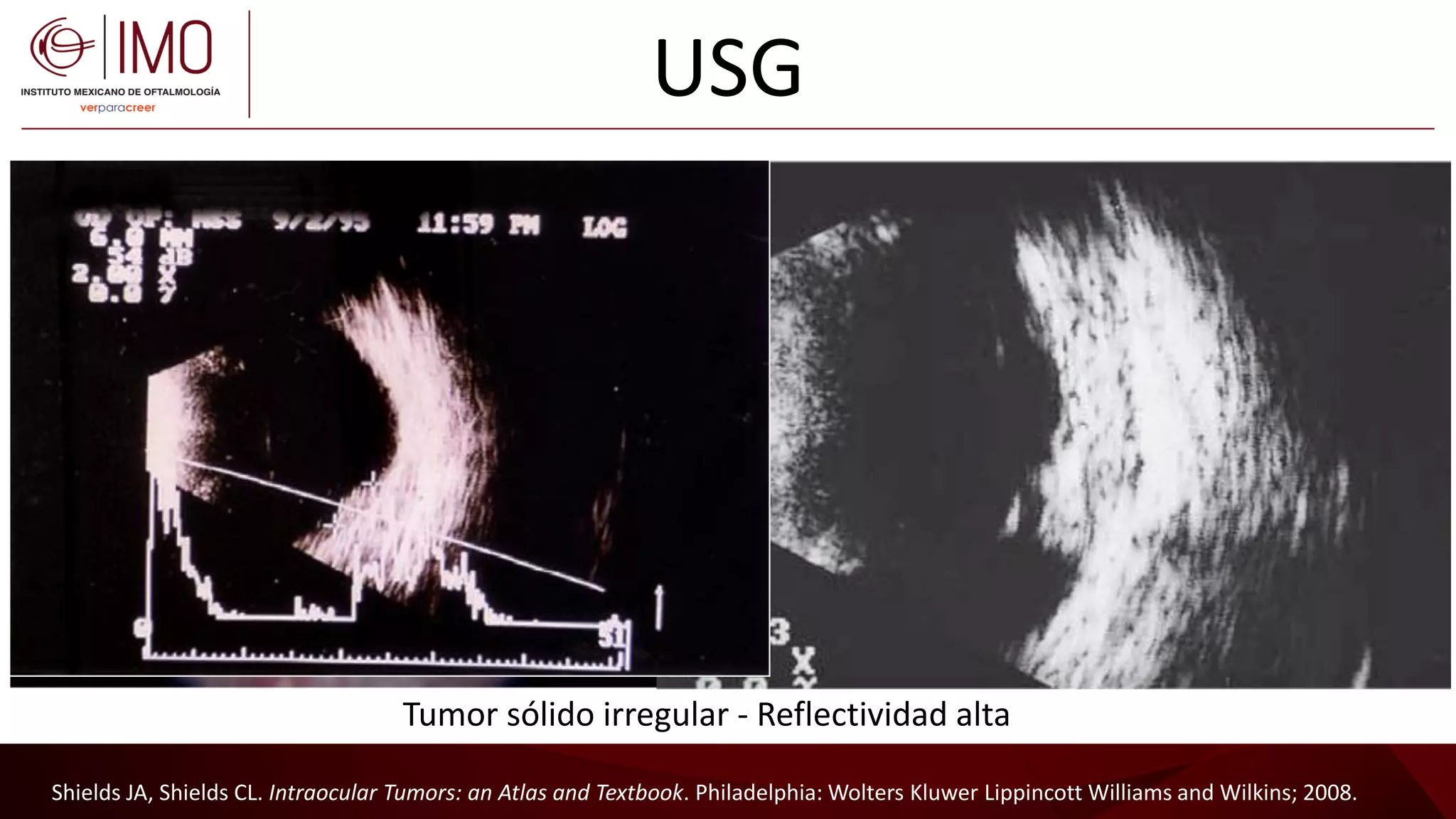 Tumores vasculares de la retina y coroides - Vascular tumors of the ...