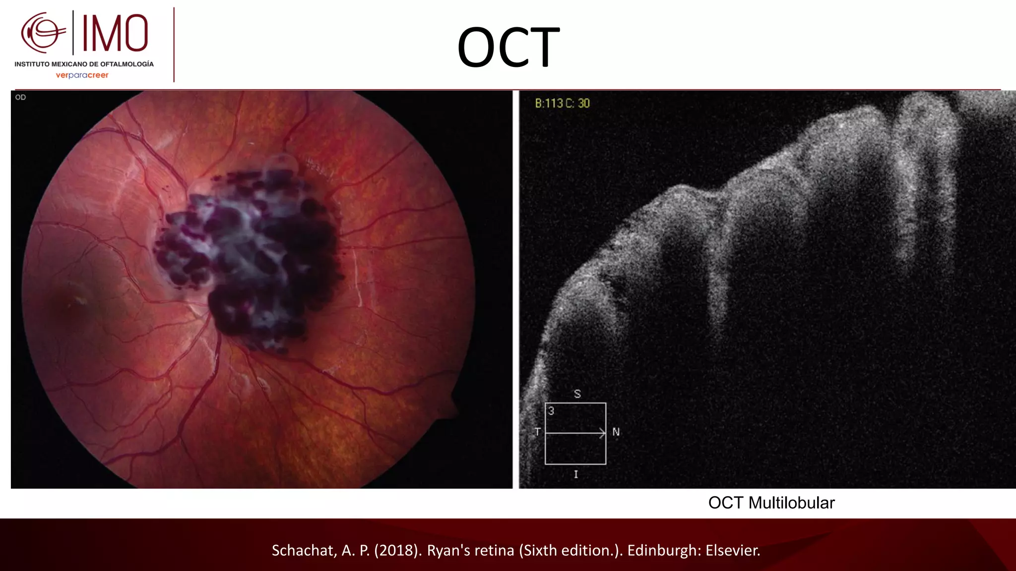 Tumores vasculares de la retina y coroides - Vascular tumors of the ...