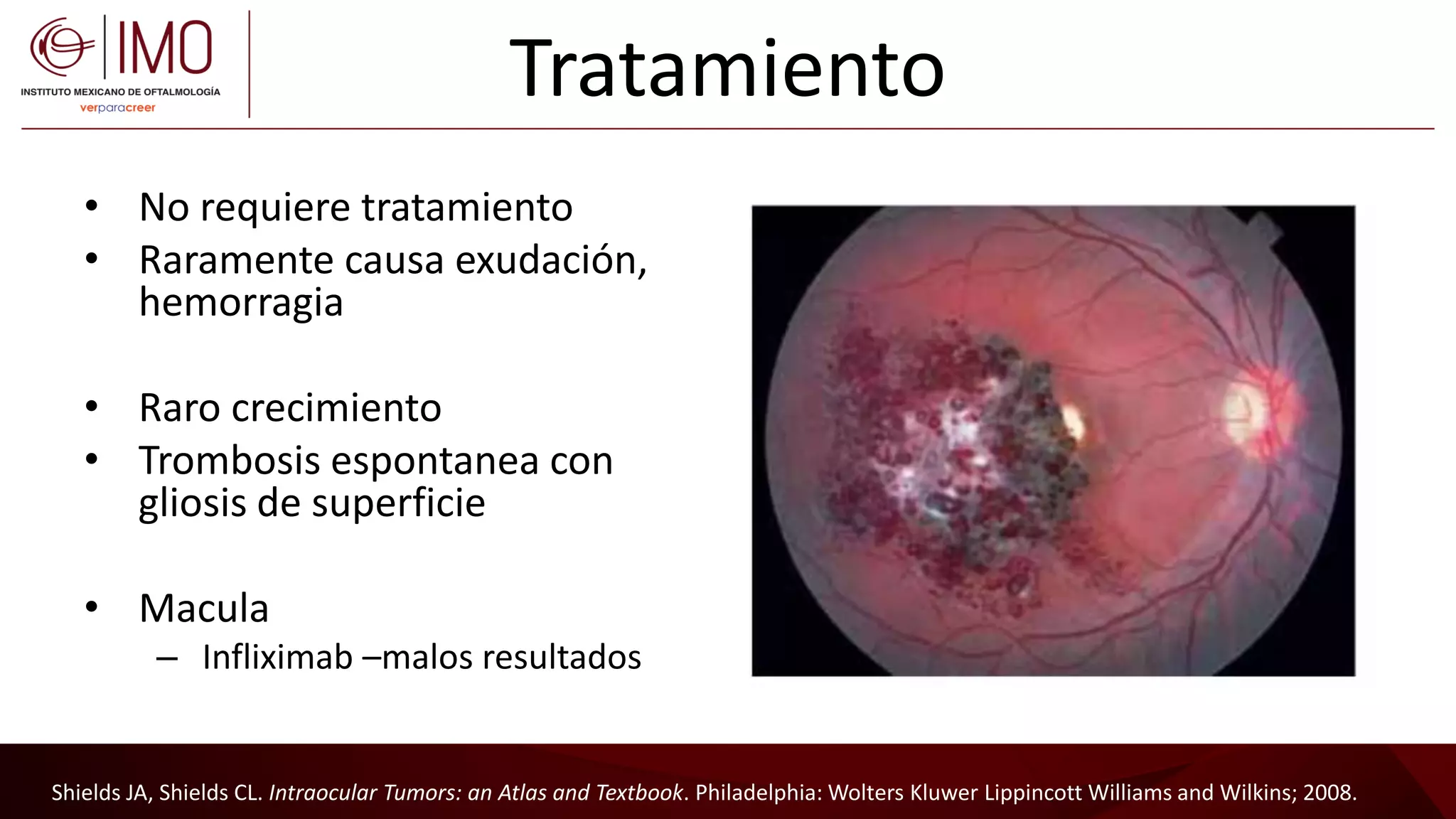 Tumores vasculares de la retina y coroides - Vascular tumors of the ...