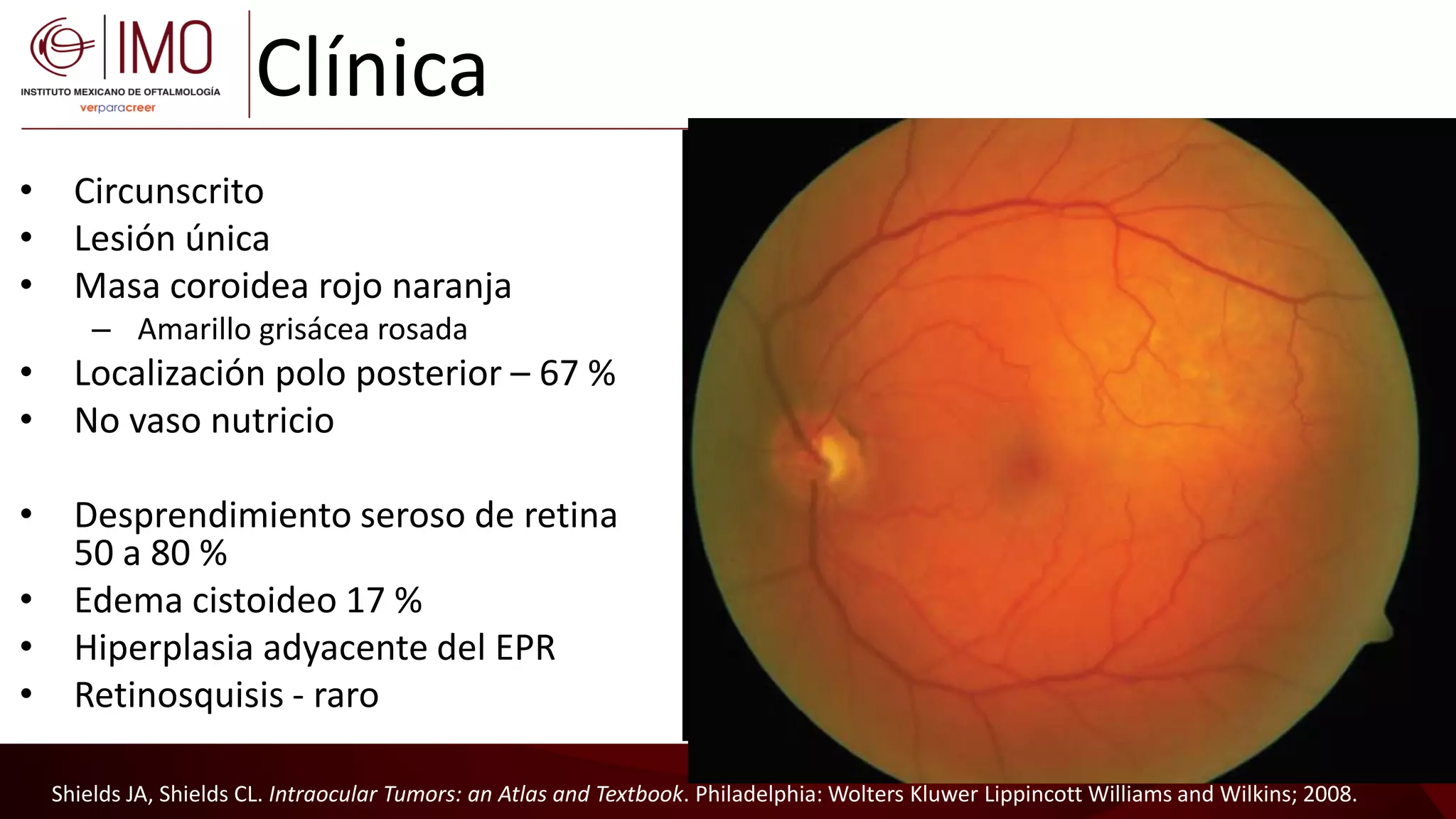 Tumores vasculares de la retina y coroides - Vascular tumors of the ...
