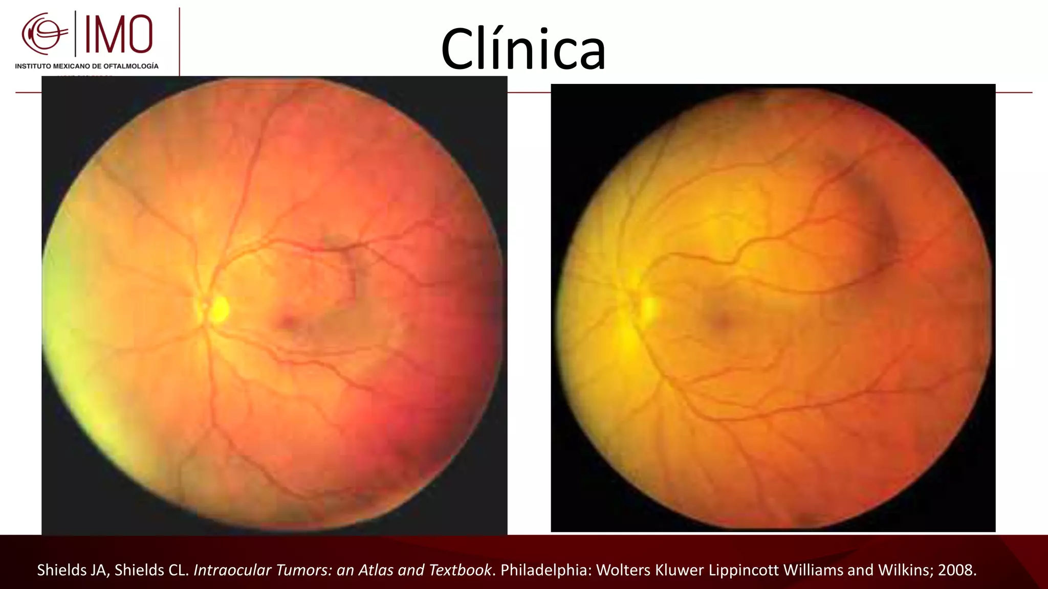 Tumores vasculares de la retina y coroides - Vascular tumors of the ...