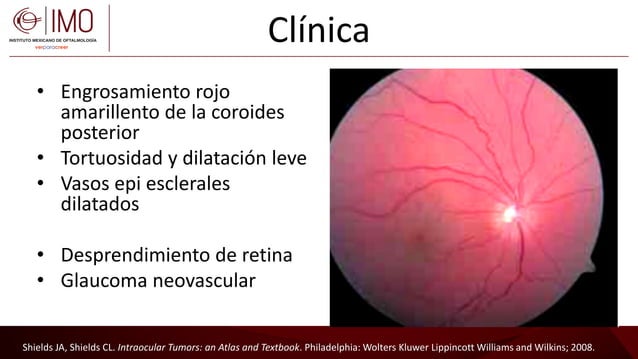 Tumores vasculares de la retina y coroides - Vascular tumors of the ...