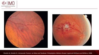Tumores vasculares de la retina y coroides - Vascular tumors of the ...