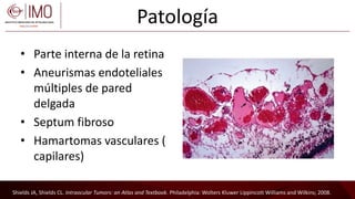Tumores vasculares de la retina y coroides - Vascular tumors of the ...