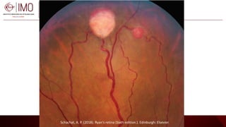 Tumores vasculares de la retina y coroides - Vascular tumors of the ...