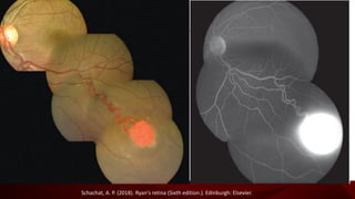 Tumores vasculares de la retina y coroides - Vascular tumors of the ...