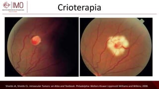 Tumores vasculares de la retina y coroides - Vascular tumors of the ...
