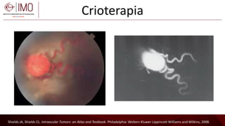 Tumores vasculares de la retina y coroides - Vascular tumors of the ...