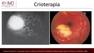 Tumores vasculares de la retina y coroides - Vascular tumors of the ...