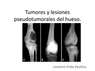 Tumores y lesiones
pseudotumorales del hueso.
Lameiro Frida Paulina
 