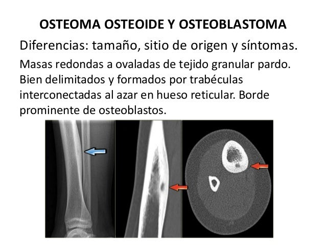 Diferencia Entre Osteoma Osteoide Y Osteoblastoma