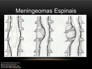 Meningeomas Espinais
 