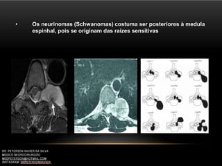 • Os neurinomas (Schwanomas) costuma ser posteriores à medula
espinhal, pois se originam das raízes sensitivas
 