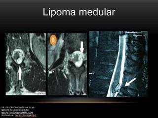 Lipoma medular
 