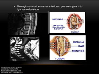 • Meningiomas costumam ser anteriores, pois se originam do
ligamento denteado
 