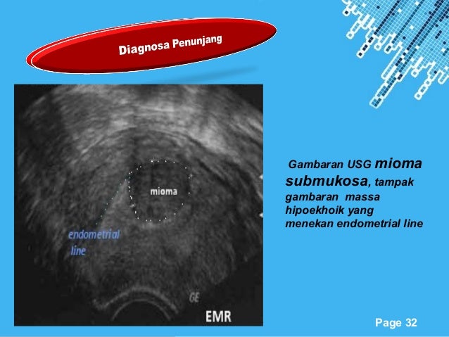 Tumor jinak & mioma uteri