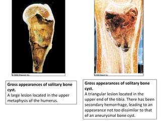 Gross appearances of solitary bone
cyst.
A triangular lesion located in the
upper end of the tibia. There has been
secondary hemorrhage, leading to an
appearance not too dissimilar to that
of an aneurysmal bone cyst.
Gross appearances of solitary bone
cyst.
A large lesion located in the upper
metaphysis of the humerus.
 