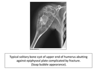 Typical solitary bone cyst of upper end of humerus abutting
against epiphyseal plate complicated by fracture.
(Soap bubble appearance).
 