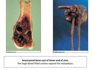Aneurysmal bone cyst of lower end of ulna.
The large blood-filled cavities expand the metaphysis.
 