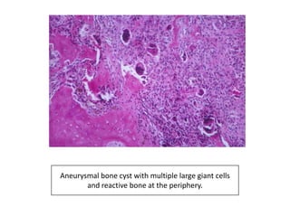Aneurysmal bone cyst with multiple large giant cells
and reactive bone at the periphery.
 
