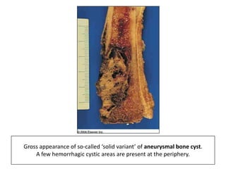 Gross appearance of so-called ‘solid variant’ of aneurysmal bone cyst.
A few hemorrhagic cystic areas are present at the periphery.
 