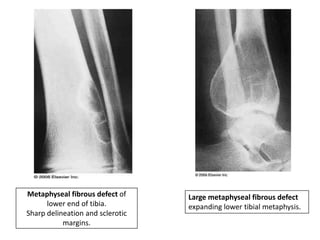 Metaphyseal fibrous defect of
lower end of tibia.
Sharp delineation and sclerotic
margins.
Large metaphyseal fibrous defect
expanding lower tibial metaphysis.
 